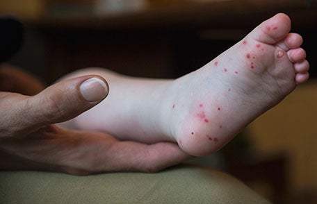 Hand, foot and mouth disease is more common in small children