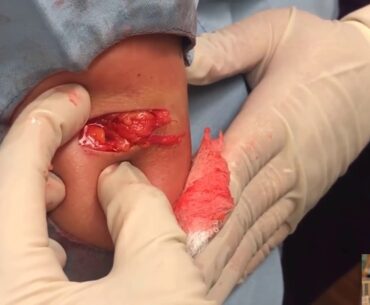 A Bicep Lipoma &  A Strong Grip
