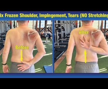 INCREDIBLE way to Fix Frozen Shoulder & Impingement - (NO Stretching or PT Exercises)