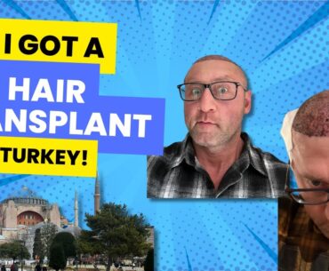 I got a HAIR TRANSPLANT in Turkey!