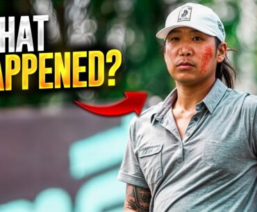 What happened to Anthony Kim's face? | Liv Golf news