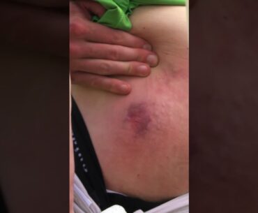 Creating the WORST Golf Ball Injury... #funny #golf #sports