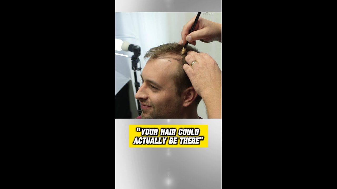What happens during a hair restortion consultation? What happens during a hair restortion consultation?