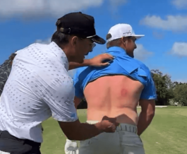 Bryson DeChambeau left with gruesome bruise after being hit with rock hard egg