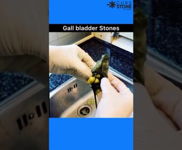 Gall bladder Stones | Laproscopic cholecystectomy | How gall bladder stones are removed