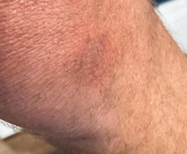 It Finally Happened. Ouch.