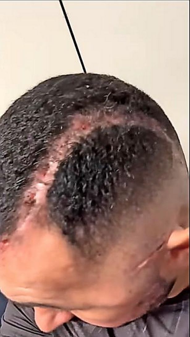 Staples in Walker's head
