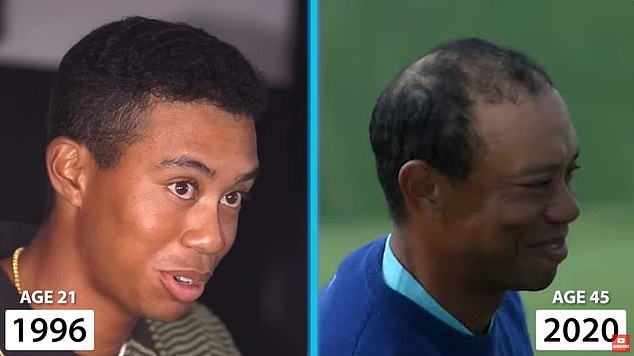 The above shows Woods with a full head of hair in his younger years, and nearer to today, with hair lost on the top of his scalp and crown