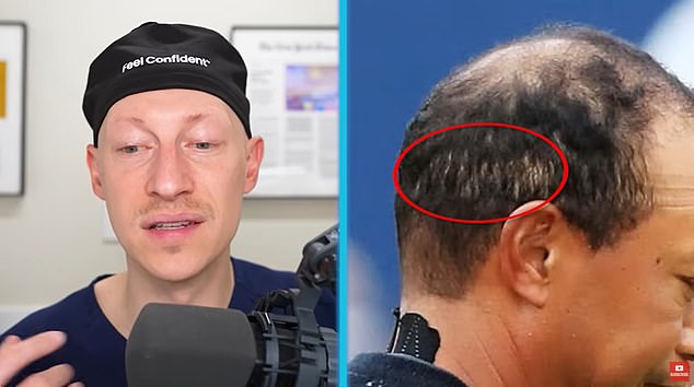 Dr Linkov pointed to this image to suggest that Woods had a scar from FUT surgery