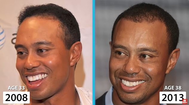 The above shows Woods in 2008 and again in 2013, just after his first alleged hair transplant surgery. His hairline appears to have become fuller and more advanced, which surgeons say would not happen with normal aging