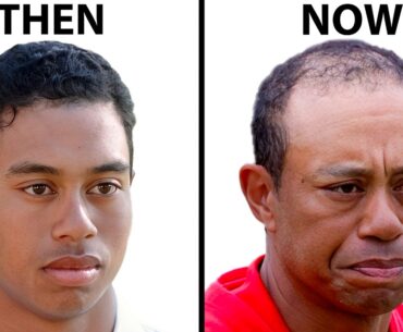 Tiger Woods Hair Transplant | Plastic Surgery Analysis