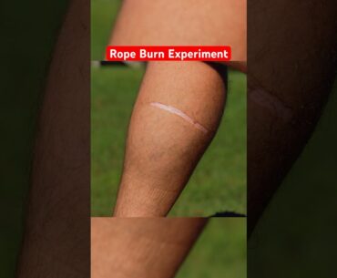 Insanely Painful ROPE BURN Experiment… #funny #science #comedy