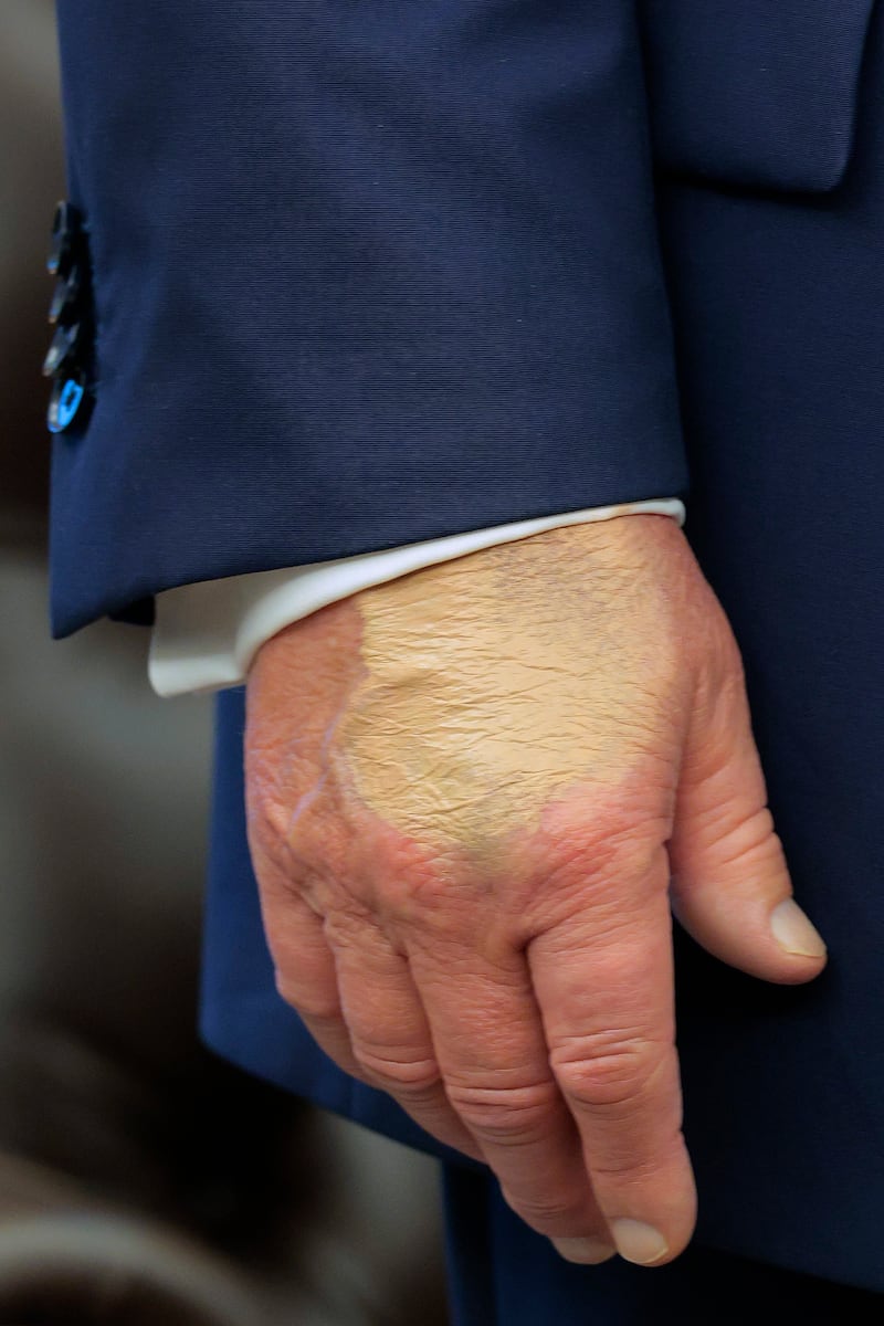 WASHINGTON, DC - AUGUST 22: A patch of discolored skin is visible on the back of U.S. President Donald Trump's hand as he talks about the FIFA World Cup in the Oval Office at the White House on August 22, 2025 in Washington, DC. Trump announced the FIFA World Cup 2026 draw will take place at The Kennedy Center.  (Photo by Chip Somodevilla/Getty Images)
