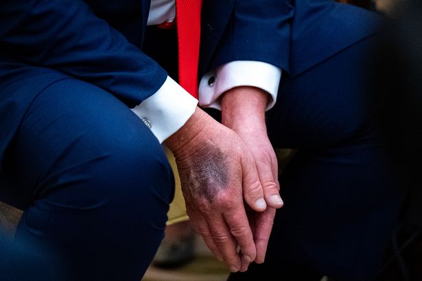 Bruises on Donald Trump's hands in the Oval Office