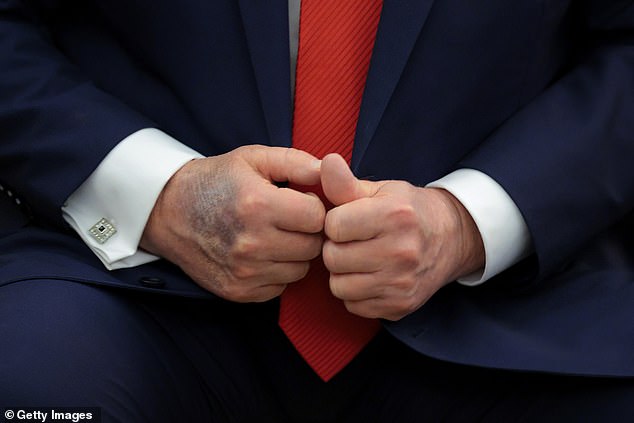 A bruise is visible on the back of U.S. President Donald Trump's right hand during a meeting with South Korean President Lee Jae-myung in the Oval Office at the White House on August 25, 2025