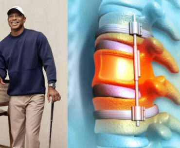 Tiger Woods Undergoes 7th Back Surgery After Collapsed Disc: Explained | Health