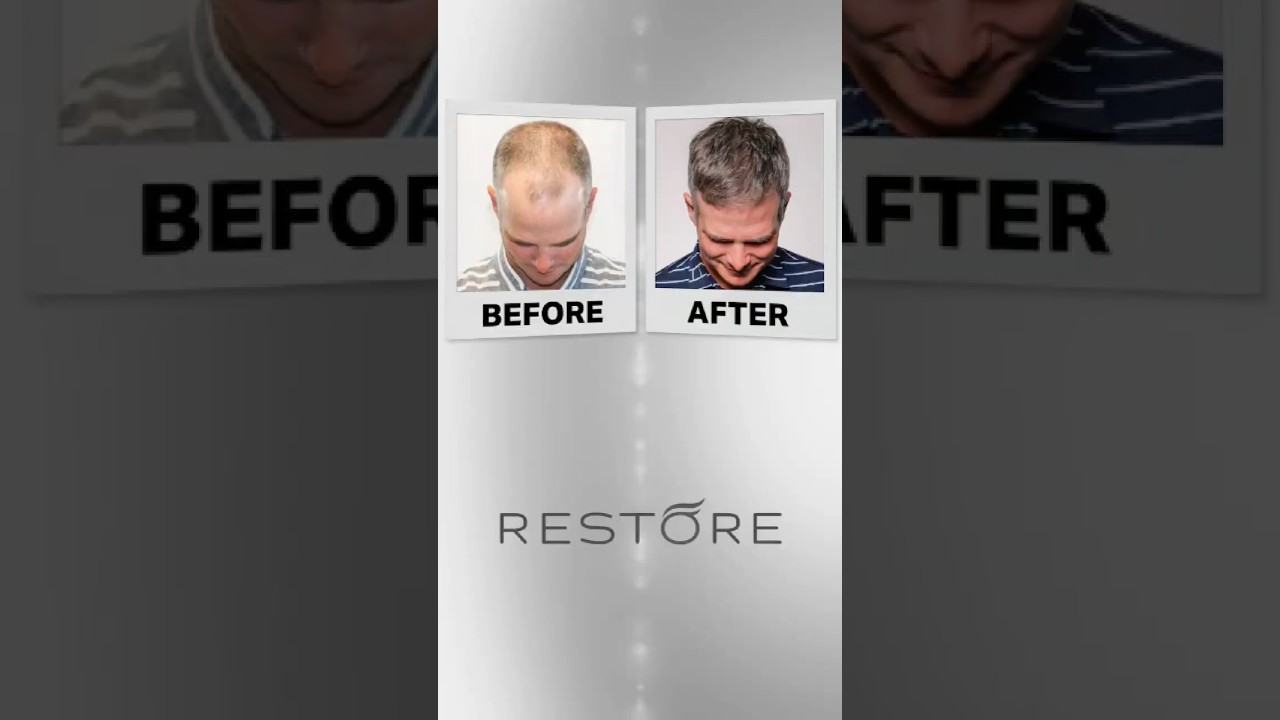 ποΈββοΈβ¨ Did Kevin Streelman get a hair transplant? ποΈββοΈβ¨ Did Kevin Streelman get a hair transplant?