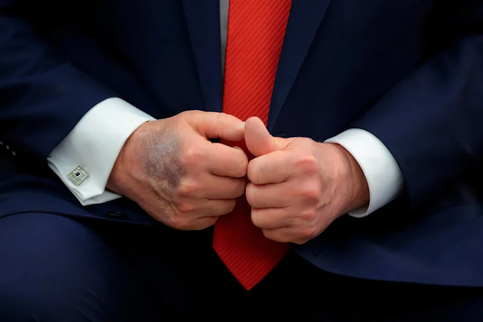 The White House claims Donald Trump's bruises are the result of rigorous handshaking by the president. / Chip Somodevilla/Getty Images
