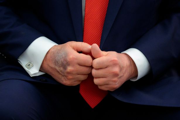 Donald Trump's bruised hands