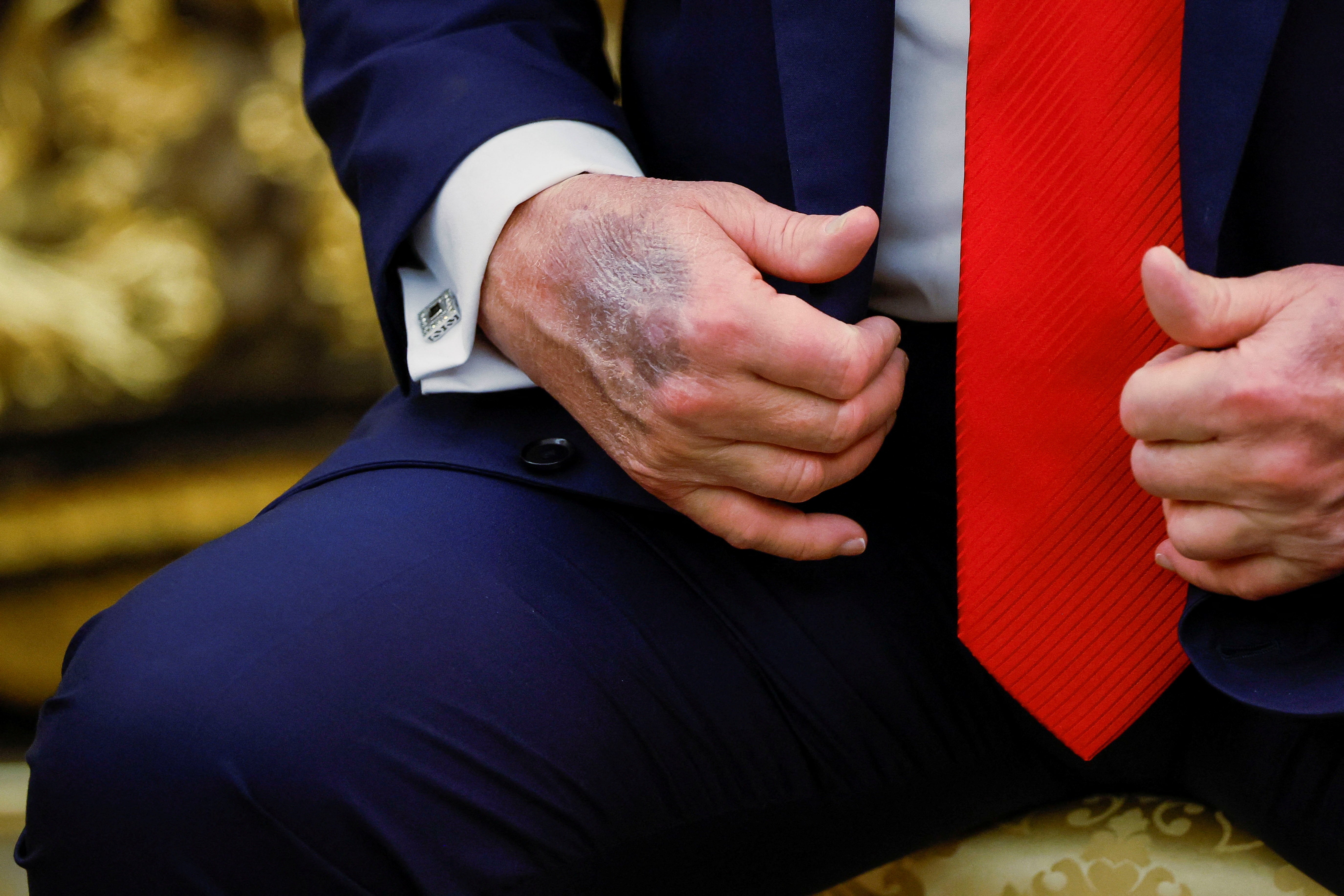 A bruise is seen on Trump’s hand during a White House meeting with South Korean President Lee Jae Myung on August 25 2025