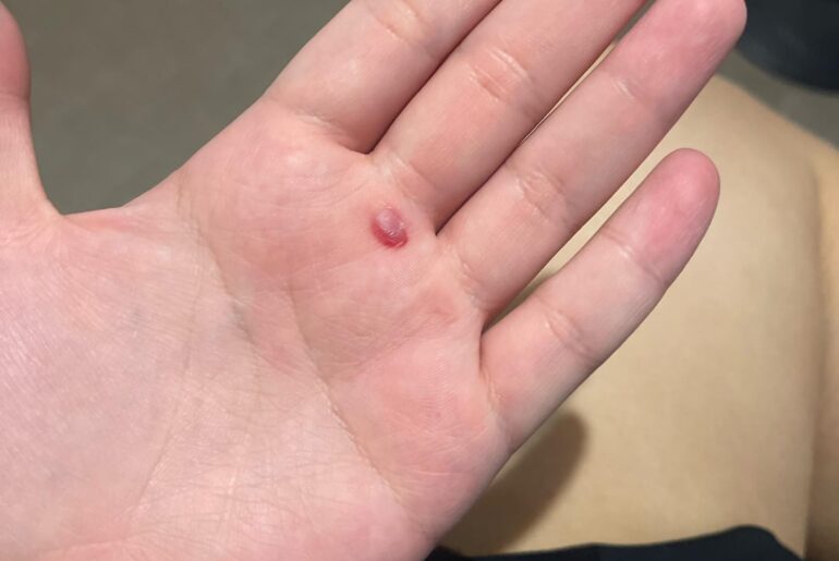 Palm blisters and fingers :( how to avoid?