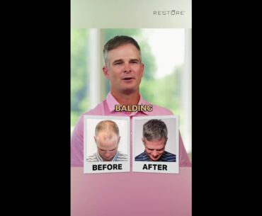 🤔 What Happens When You Stop Thinking About Balding?