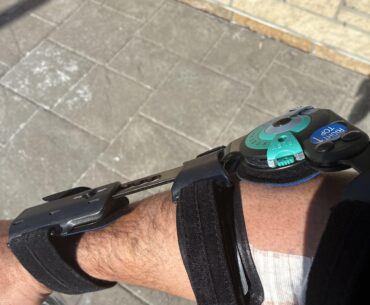 Just had distal bicep tendon repair…would love to hear some comeback stories