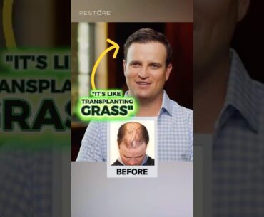 🏌️‍♂️ How does FUE Hair Transplant work?