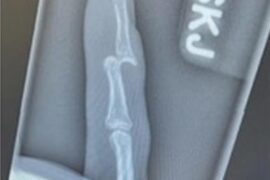 Don’t try and catch a golf ball going 80mph.